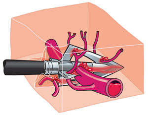 Arrow cutting through an artery