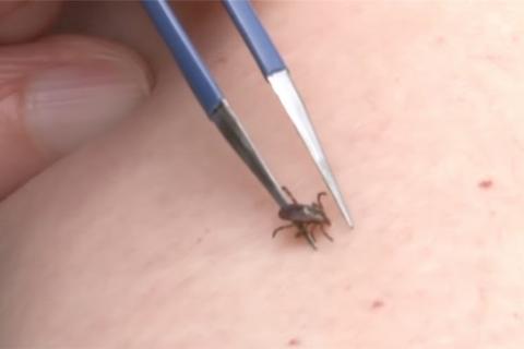 Tweezers removing tick embedded in the skin